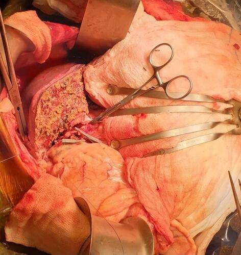 Figure 3 Intraoperative image during liver transplantation. The patient’s head is to the left. The liver is seen on the patient’s left side.