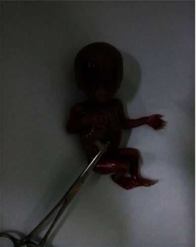 Figure 3 The fetus after removal from the cervix.
