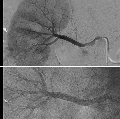 Figure 1 Severe renal artery stenosis before (top) and after (bottom) angioplasty and stenting.