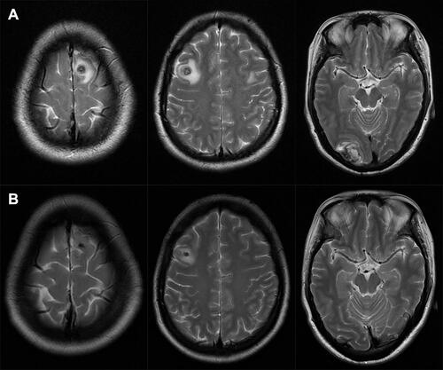 Figure 6 Brain magnetic resonance imaging (MRI) before and after chemotherapy. (A) Brain MRI before chemotherapy shows multiple nodules in bilateral frontal lobe and right occipital lobe, suggesting metastasis with a little bleeding. (B) After chemotherapy, brain MRI shows that bilateral frontal lobe and right occipital lobe nodules were smaller than before, and the peripheral edema was relieved.