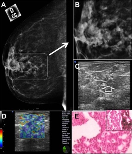 Figure 6 Clustered retroareolar microcalcifications in the right breast of a 52-year-old patient.