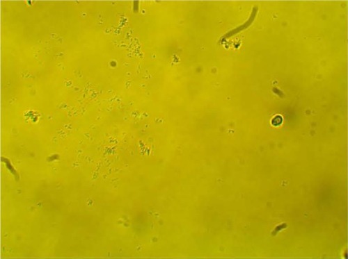 Figure 9 Clumping of lactobacilli with semicircular ridge formation.