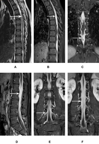 Figure 1 The irregularly thickened meninges of intraspinal tuberculosis show obvious homogeneous enhancement on MR images.Notes: Intraspinal tuberculosis in a 21-year-old male. Sagittal T2WI (A) shows a slight hyperintensity of the irregularly thickened meninges (white arrow) and edema of the involved spinal cord. Gadolinium contrast MR images (B–F) show obvious enhancement of irregularly thickened meninges in the thoracic and lumbar segments (white arrow) that integrate with each other. Nerve roots are thickened with obvious enhancement bilaterally (E, white arrow).Abbreviations: T2WI, T2-weighted imaging; MR, magnetic resonance.