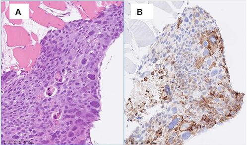 Figure 3 Pathological section of RPLN metastasis biopsy. The biopsy specimen showed the infiltration of mixed germ cell cancer. Immunohistochemistry revealed strong positive staining for PD-L1. (A) Hematoxylin and eosin staining. (B) VENTANA (SP-142) immunohistochemistry assay, magnification: 200x.