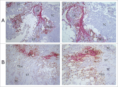 Figure 1. Lymphocyte infiltration of MPM tissue samples. Pictures were taken from slides of two different MPM patients (A) and (B). The lymphocyte infiltration of both tissue samples is representative for those in our overall MPM cohort. The images show the presence of lymphoid aggregates, CD4+ (red) and CD8+ (brown) lymphocytes in the tumoral stroma and around the tumor cells. In patient (A), tumor cells are epitheloid and pleiomorfic, directly surrounded by TILs. The stroma has a low density, while in patient (B) the stroma has a higher density. Tumor cells are smaller and surrounded by stroma with TILs in it. Original magnification: left column pictures 100×; right column pictures 200×. LA, lymphoid aggregate; TC, tumor cells; TILs, tumor-infiltrating lymphocytes; ST, stroma.