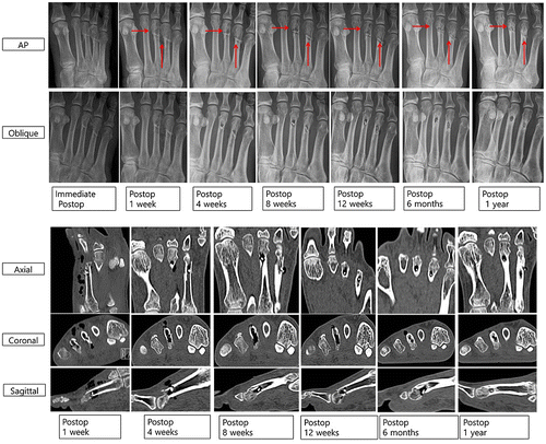 Figure 6. Foot AP and oblique X-ray images of gas formation by magnesium screw (red arrows), and axial, coronal, and sagittal CT scan images of air bubbles surrounding magnesium screw inserted into metatarsal fracture for 12 months.