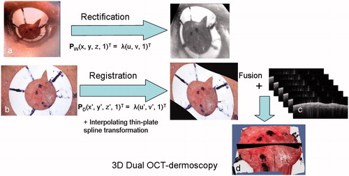 Figure 8. A diagram illustrating the main steps in the algorithm including the rectification of the webcam image of the lesion (a), showing the fiducial marker, and the registration of the dermoscopy image with the rectified webcam image (b), followed by fusion with the OCT image stack (c) to form a 3D combined OCT-dermoscopy image (d).