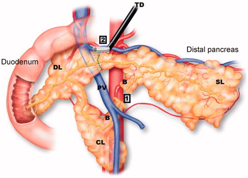 Figure 1. Normal anatomy of the porcine pancreas and the surgical procedure after the first section of the pancreas according to Ferrer et al. [Citation12]. The ‘splenic’ lobe (SL), corresponding to the tail and body in the human pancreas, is attached to the spleen. The ‘duodenal’ lobe (DL), corresponding to the head of the pancreas, is located adjacent to the duodenum while the ‘connecting’ lobe (CL), corresponding to the uncinated process is an extension of the pancreas which is anterior to the portal vein (PV). There is also a ‘bridge’ (B) of pancreatic tissue serving as an anatomical connection between the splenic and connecting lobes behind the portal vein. In order to achieve a complete separation of the distal part (body and tail) two transection planes were performed (numbers 1 and 2) with the transection device (TD) (either RF electrode or mechanical stapler).