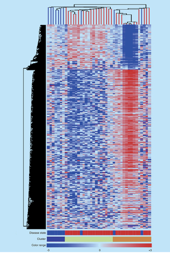 Figure 1.  Unsupervised hierarchical clustering of control and sporadic amyotrophic lateral sclerosis patients.The figure shows as, by an unsupervised hierarchical clustering (similarity measure: Pearson centered; linkage rule: average), we were able to separate control (ten fresh-frozen motor cortex samples from individuals who had died from a non-neurological disease) from SALS patients (31 fresh-frozen motor cortex samples) on the basis of similarity in their expression patterns in motor cortex (considering the 9646 most informative genes, with an SD >1.5). In addition, this clustering allowed us to segregate sproadic amyotrophic lateral sclerosis (SALS) patients in two greatly divergent groups (SALS1 and SALS2). In the 2D presentation, each row represents a single gene and each column a motor cortex from control or SALS patients. Highly expressed genes are shown in red, downregulated genes in blue, no change in white. In the dendrograms shown (left and top), the length and the subdivision of the branches display the relatedness of the expression of the genes (left) and the motor cortex (top). The disease state is marked as follows: controls patients are indicated by blue rectangles and SALS patients by red rectangles. In the cluster panel, blue rectangle refers to control patients, yellow to SALS1 and orange to SALS2 patients. For further details, the reader is referred to [Citation7].