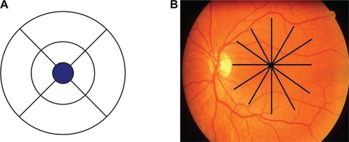 Figure 1 (A) The macular diameter map in mm with 9 regions centered around the foveal thickness (blue circle). (B) The macula with six radial lines centered on the fovea, each line equally oriented from the other (30 degrees between).