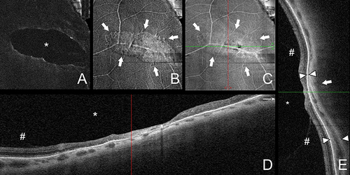 Figure 4 Optical coherence tomography in lattice degeneration. (A) Structural en face projection of a 10-µm preretinal slab showing vitreous liquification (asterisk) over the lesion. (B) Structural en face projection of a 10-µm epiretinal slab showing vitreous adhesions (arrows) within the lesion. (C) Structural en face projection of inner retina slab vitreous showing the lesion (arrows). Green and red line show position of cross-sectional scans in (D and E). (D) Cross-sectional scan passing along the lesions shows vitreous liquification (asterisk), vitreous adhesions (number sign) at the borders of the lesions, and retinal thinning (E). (D) Cross-sectional scan passing the lesions crosswise shows vitreous liquification (asterisk), vitreous adhesions (number sign) at the borders of the lesions, and retinal thinning. Arrowheads show choroidal thinning at the lesion compared to an unaffected region. Arrow indicates dome-shaped scleral indentation beneath the lesion.