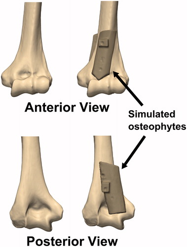 Figure 2. Simulated osteophytes made from harvested cortical bone were affixed to the anterior and posterior surface of the distal humerus. The simulated osteophytes were positioned such that they would partially obstruct the coronoid and olecranon fossae and impinge with the coronoid and olecranon tips during flexion and extension motions, respectively.