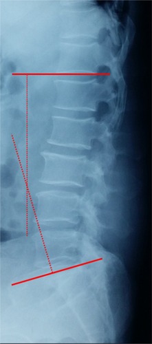 Figure 1 Lumbar lordosis was measured from T12 inferior end plate to S1 superior end plate by the Cobb method.