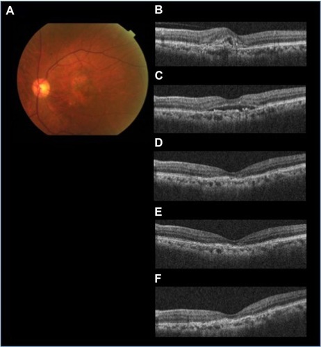 Figure 1 The efficacy of aflibercept for treating AMD resistant to ranibizumab (patient 3 with occult CNV).