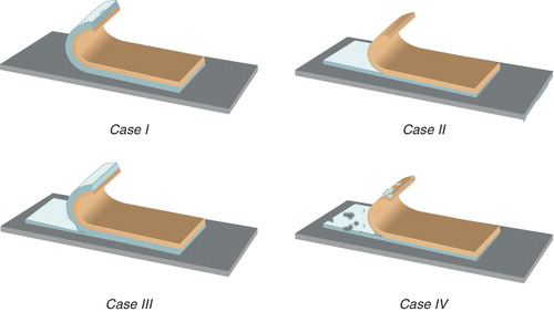Figure 1. Patch modes of failure. When a patch is peeled away from an adherend, four types of failure can occur. Case I (adhesive failure) is the only acceptable form of patches. When the pressure-sensitive adhesive does not strictly adhere to the backing layer, it may transfer to the adherend, leaving no matrix on the backing layer (case II). Case III refers to what happens when the matrix has good adhesive strength but poor cohesive strength. Case IV is a combination of adhesive and cohesive failure at the same time. The shift from one to another type of failure is affected not only by additives but also by peel rate Citation[20].