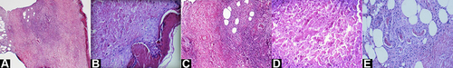 Figure 4 Left thigh root skin biopsy. (A) Focal hypokeratosis, formation of serous callus, atrophy, and thinning of the epidermis (hematoxylin staining [HE] × 40). (B) Extensive liquefaction and degeneration of the cells in the basal layer (HE × 200). (C) Fibrinoid necrosis of the vessel wall at the reticular layer of the dermis (HE × 100). (D) Extensive collagen fiber necrosis and mixed inflammatory cell infiltration dominated by lymphocytes and neutrophils can be seen around the blood vessel and between the collagen fibers, and eosinophils are rare (HE × 100). (E) Subcutaneous adipose tissue septal hyperplasia, where thrombosis is seen in the vascular cavity and some fat cells are degenerated and necrotic (HE × 200).