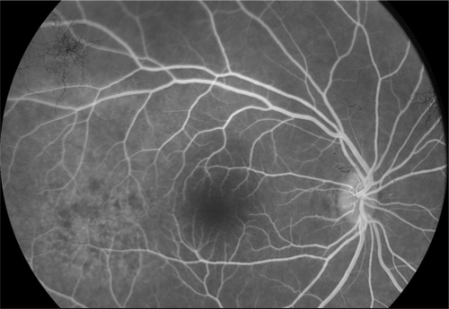 Figure 8 Case 2. Fluorescein angiography 2 weeks after the first examination. Punctuated hyperfluorescence in place of the initial lesion, suggesting retinal pigment epithelium atrophy.