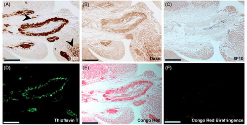 Figure 5. 14G8 specifically identifies amyloidogenic TTR deposits in human ATTR amyloidosis cardiac tissue. Immunohistochemical labeling of cardiac tissue derived from an ATTR amyloidosis patient harboring the I84S mutation. (A) 14G8 mis-TTR mAb and (B) total-TTR pAb (DAKO) immunoreactivities were overlapping and identified comparable deposits in the myocardium and vasculature that were not immunoreactive for anti-6F10 (C), an isotype control. Lower-intensity immunohistochemical labeling with 14G8 (black arrows, A) was found in regions not staining for amyloid, and thus may represent pre-amyloidogenic TTR deposits. These same deposits were also labeled by thioflavin T (D) and Congo red (E), which confirmed the amyloid nature of these deposits. Congo red birefringence (F) aligned with the same areas showing the greatest amount of TTR deposits. Scale bar = 500 μm.
