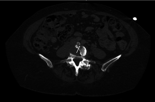 Figure 1 Iliac vein compression visualized on computed tomography of the abdomen and pelvis (circled in white. White arrow pointing to the compressed left common iliac vein).