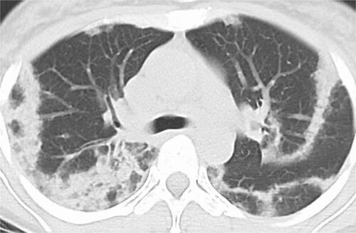 Figure 2 Chest CT with the lung window setting shows infiltrations in bilateral peripheral lung fields.
