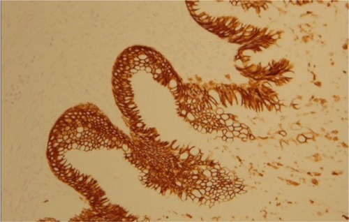 Figure 6 Cytokeratin 20 diffusely positive staining (×10).