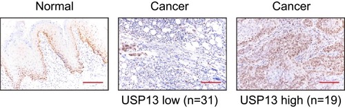 Figure 1 Decreased expression of USP13 in OSCC.