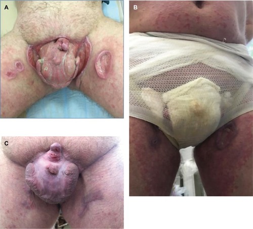 Figure 1 (A) Major ulcers, 15 cm in diameter, with clear lines, elevated cyanotic edges on the front surface of the scrotum. The surface was presented by tender granulations, with parts showing yellow purulent discharge thickenings. On the internal surface of the hips there were ulcers 3×5 cm in size, with clear lines, even edges, and tender granulations on the bottom of the ulcers and yellow-green purulent discharge thickenings. The penis was deformed, and was actually presented by the urethra, covered with granulation tissue (before the treatment). (B) Occlusive dressing with an epithelizing ointment. (C) Complete healing through granulation and scarring of ulcers on completion of the 24-week treatment.