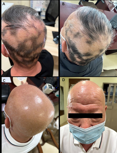 Figure 1 Multiple well-defined patches of hair loss after 1 month of oral sacubitril/alisartan (A); discontinuation of sacubitril/alisartan with an increase in the hair loss area after 2 months (B); complete loss of scalp hair and nearly complete eyebrow loss after 6 months (C and D).