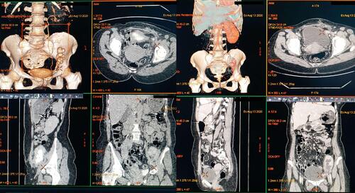 Figure 4 Abdomen and pelvis CT scan 2 months after surgery shows significant hydronephrosis of the transplanted kidney. However, this is the old hydronephrosis (the antegrade nephrostogram before the surgery have shown that).