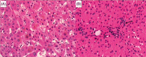 Figure 6. Normal untreated parenchyma (A) and ablated parenchyma (B) (magnification ×20, H&E stain). Hepatocytes within the white zone exhibit central nuclear smearing (arrow), have increased density (hyperchromasia), and have taken on a slightly shrunken appearance. The characteristic cellular anatomy is well maintained between ablated and non-ablated tissue.