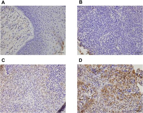 Figure 1 Expression of AATF in HNSCC. (A) Negative AATF staining in normal laryngeal squamous epithelium tissue. (B) Negative AATF staining in a case of HNSCC. (C) Moderate nuclear AATF staining was found in about 60% tumor cells of an HNSCC specimen. (D) Strong AATF nuclear staining in a case of HNSCC with about 90% positivity. (Magnification: 400×; bars indicates 50µm).