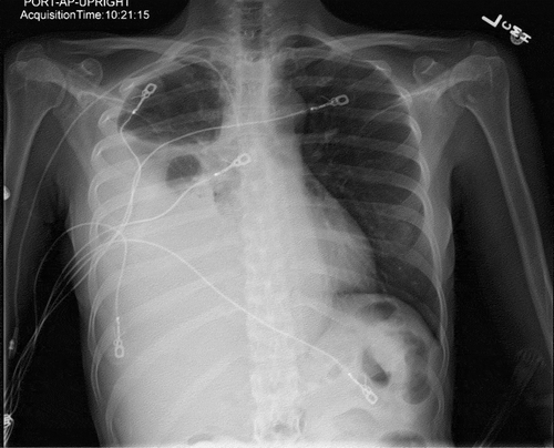 Figure 2. Chest x-ray showed large right pleural effusion with near complete collapse of the right lower lobe.