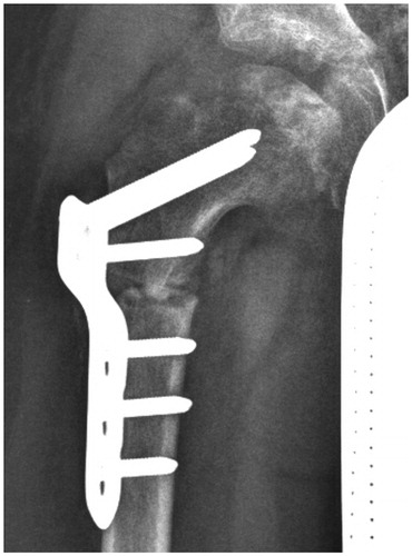 Figure 6. Six weeks postoperatively.