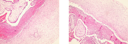 Figure 2 Pathologic sections of placental tissue in pregnant patient from in different fields of view.
