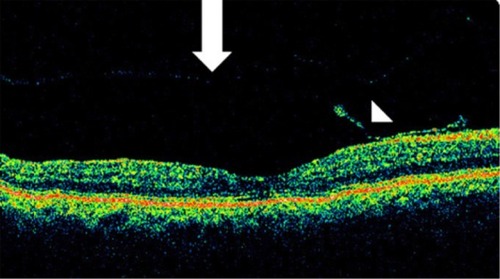 Figure 35 Stratus optical coherence tomography image.