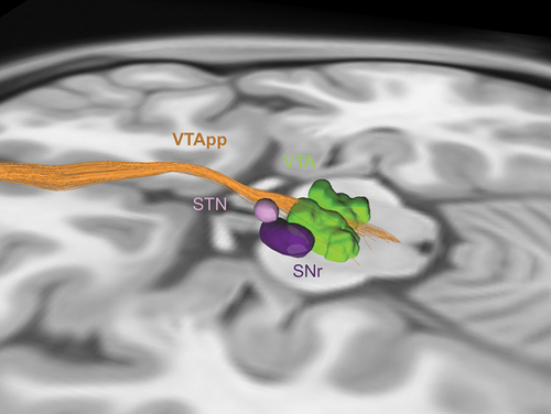 Figure 3. Tractography for ventral tegmental area projection pathway (VTApp) DBS. Lead placement for VTApp DBS is primarily guided by tractography. The target is the VTApp (orange) as it exits the ventral tegmental area (VTA) (green), bordered by the subthalamic nucleus (STN) (light purple) and substantia nigra pars reticulate (SNr) (dark purple) laterally, the red nucleus posteriorly (not shown), and the mammillary body anteriorly (not shown).