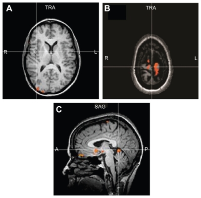 Figure 3 Demonstrates no activity in the pain regions (A) of the controls during the SLR maneuver. There is activation in the leg sensory motor region S1 (B) and anterior cerebellum (C).