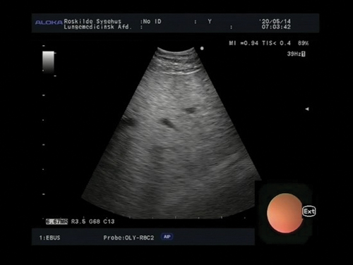 Figure 8. EUS-B image of the liver.
