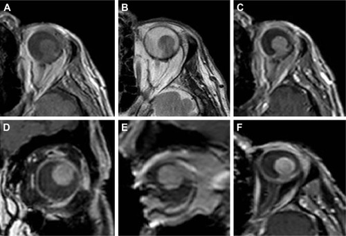 Figure 3 Characteristic appearance of choroidal melanoma on MRI.