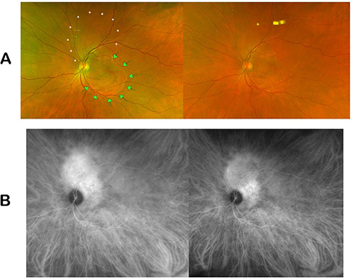 Figure 3 Comparison of (A) fundus images and (B) indocyanine-green angiographic images pre- and post-treatment with half-fluence PDT and aflibercept taken at presentation and eleven and a half weeks after treatment.