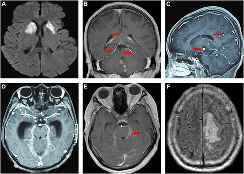 Figure 2 (A–F) Brain MRI scan abnormalities observed in tuberculous meningitis. (A) Diffusion-weighted image (DWI) showed acute infarction in bilateral basal ganglia. (B) Post-contrast MRI showed thickening and strengthening of the dura mater (arrows). (C) Post-contrast MRI showed multiple miliary tuberculosis (arrows). (D) Post-contrast MRI showed severe hydrocephalus secondary to TBM. (E) Post-contrast MRI showed basal meningeal enhancement (arrows). (F) MRI FLAIR sequence showed edema in the left frontal and parietal lobes.