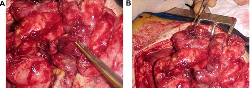 Figure 2 White/yellowish lesions and ileal, duodenal, and gastric perforations.