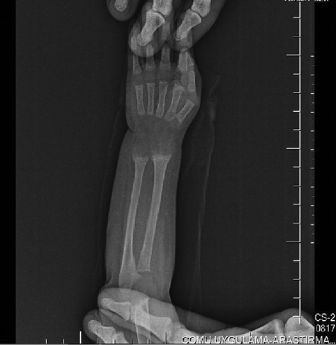 Figure 1.  Radiography of wrist showing signs of rickets.
