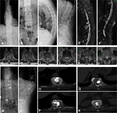 Figure 1 An 80-year-old man with spine metastases treated with PVP and suffered from intra-spinal canal cement leakage (before surgery). (A) Preoperative anteroposterior thoracic vertebral radiography showed vertebral collapse at T10 and L1; (B) Preoperative anteroposterior lumbar vertebral radiography revealed vertebral collapse at L1; (C) Preoperative lateral thoracic vertebral radiography showed vertebral collapse at T10 and L1; (D). Preoperative lateral lumbar vertebral radiography showed vertebral collapse at L1; (E) Preoperative sagittal thoracic vertebral MRI showed multiple spine metastases and vertebral collapse at T10 and L1; (F) Preoperative sagittal lumbar vertebral MRI showed multiple spine metastases and vertebral collapse at T10 and L1; (G) Preoperative transversal T10 MRI showed deformation of the dural sac, but no spinal cord or nerve root compression; (H) Preoperative transversal MRI at T11 showed metastatic lesion; (I) Preoperative transversal MRI at T12 showed metastatic lesion; (J) Preoperative transversal MRI at L1 showed metastatic lesion; (K) Preoperative transversal MRI at L2 showed metastatic lesion; (L) Preoperative transversal MRI at L5 showed metastatic lesion; (M) Postoperative anteroposterior lumbar vertebral radiography revealed bone cement at T10, T11, T12, L1, L2, and L5; (N) Postoperative lateral vertebral radiography showed bone cement at T10, T11, T12, L1, L2, and L5; (O) Postoperative transversal CT at T10 showed distribution of bone cement; (P) Postoperative transversal CT at T11 showed intra-spinal canal cement leakage; (Q) Postoperative transversal CT at T12 showed intra-spinal canal cement leakage; (R) Postoperative transversal CT at L1 showed intra-spinal canal cement leakage.