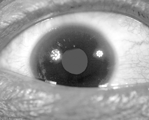FIGURE 1  Pupil examination facilitated by near-ultraviolet fluorescence of the lens. Note that two near-ultraviolet light sources were used for the purpose of this photograph.