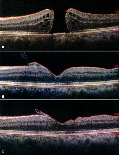 Figure 4 Case 1. (A) Preoperative OCT shows a large full-thickness macular hole. (B) 1 month postoperatively, the inverted flap is visualized as a hyperreflective tissue nasal to the fovea. (C) OCT 3 months after surgery shows some degree of atrophic change in the inner retinal surface limited to the temporal side of fovea.