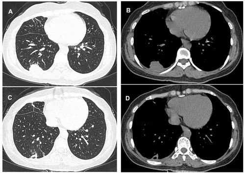 Figure 7 Case 4. CT findings in the right-inferior pulmonary lobe. (A and B) A mass measuring 3.3cm×2.0cm was found after three months of anti-tuberculosis therapy. (C and D) The mass was irregular with a cavity.