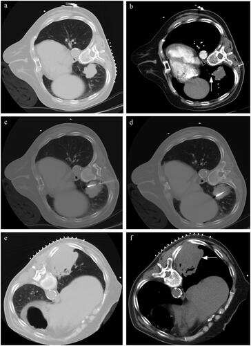 Figure 5. A typical case. (a) A patient with suspected NSCLC was admitted. The pre-MWA CT scan revealed the location and size of the lesion (4 cm in maximum tumor diameter). (b) The contrast-enhanced CT scan reveals the presence of vessels ≥3mm in direct contact with tumor (white arrow). (c,d) Synchronous coaxial-cannula biopsy and MWA were performed, with multiple adjustments of the MWA needle during the procedure. The histopathological subtype was squamous cell carcinoma. The total points for local progression on the nomogram were approximately 150 points. The estimated risk of local progression after MWA was approximately 0.44 for this patient, which indicated a high risk of local progression and was monitored by radiological reexamination. (e,f) The CT reexamination was performed every 3 months, and the local progression was detected one year after MWA (white arrow).