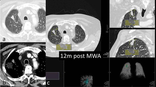 Figure 3. 68y-year-old male with biopsy proven RUL adenocarcinoma, 12-months assessment. a. axial CT scan lung window shows slow shrinkage of the index lesion, still larger than pre-ablation b. density decreased by approximately one third from the 6-month scan c. volumetric assessment – volume 4040mm3 compared to 905mm3 pre ablation; max length 25.8mm compared to 19.4mm pre ablation.