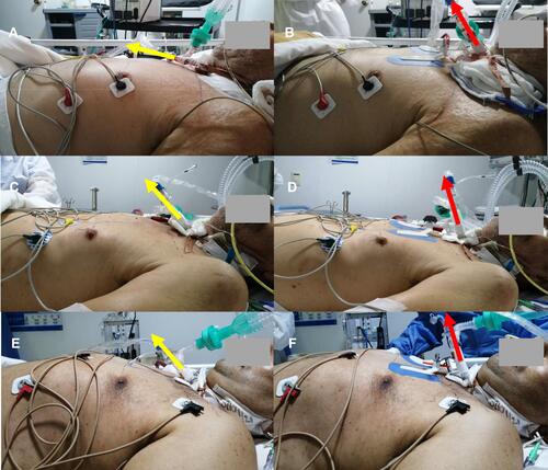 Figure 7 Patient With DYNAtraq Dispositive: Lateral View In Supine Position Comparisons Between Sequential Photographs Taken Prior To And After The Placement Of The DYNAtraq Device In Ventilated PatientS. Sequential pictures from three selected patients to show latero-lateral view of intrasubject comparisons prior to and after the placement of the DYNAtraq device. Pictures (A, C and E) represent the referent latero-lateral photograph of the patients without the device, whereas pictures (B, D and F) show latero-lateral photographs of the same patient once the device has been placed on the chest following the interclavicular line reference. Color code: (Yellow arrows): axis of the tracheostomy tube alignment at baseline (without the device) position; (Red arrows): axis of the tracheostomy tubes using the DYNAtraq device.